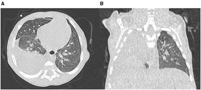 An Unexpected Hepatic Hydrothorax After a Successful Kasai Portoenterostomy: A Case Report